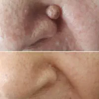 خدمات خالبرداری کک مک ،لک ،هایفو
