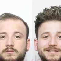 پروتزمو/ تعویض چسب/تخفیف ویژه|خدمات آرایشگری و زیبایی|شیراز, فرگاز|دیوار