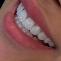 اموزش کامپوزیت ونیر زیبایی