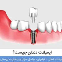 ایمپلنت دندان ۷۹۰۰ با ضمانت ۲۰ ساله|خدمات آرایشگری و زیبایی|کرج, عظیمیه|دیوار