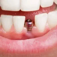 مرکزفوق تخصصی ایمپلنت دیجیتال مشهد/سبک کاخ لبخند