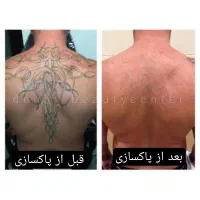 قویترین پاکسازی تاتو.درمان لک.ماه گرفتگی.کربنتراپی|خدمات آرایشگری و زیبایی|یاسوج, |دیوار
