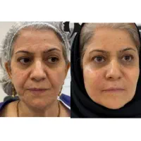 تزریق ژل/فیلر فقط تا پنجشنبه(جشنواره)درمطب فقط499ت|خدمات آرایشگری و زیبایی|اصفهان, باغ زیار|دیوار