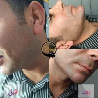 تزریق ژل،بوتاکس،آنزیم،پی آر پی، مزو ژل برای آقایان|خدمات آرایشگری و زیبایی|خرمشهر, |دیوار