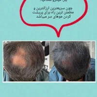 میکرو اسکالپ|خدمات آرایشگری و زیبایی|تهران, جنت‌آباد جنوبی|دیوار