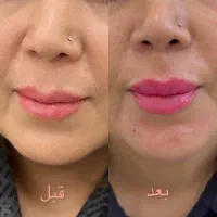 تخفیف ویژه ژل و بوتاکس و فیشیال