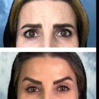 فیلر بوتاکس مزو ابرو مزوصورت جوانسز