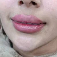 خدمات ژل و بوتاکس