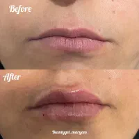 ژل و بوتاکس