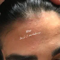 پاکسازی و فیشیال پوست  ازبین بردن لک مخصوص بانوان|خدمات آرایشگری و زیبایی|آمل, |دیوار