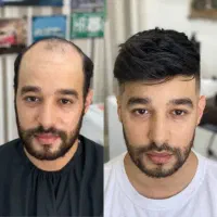 اف کاشت مو