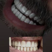 دندان مصنوعی و کامپوزیت|خدمات آرایشگری و زیبایی|سروآباد, |دیوار