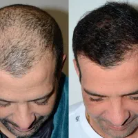 کاشت مو زیر ۱۰ میلیون بیمارستان فوق تخصصی پاستور