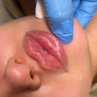 جشنواره تزریق فیلر ب مدت محدود فقط ۷۸۰تومن