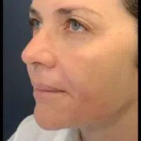 جشنواره تخفیف جراحی لیفت صورت|خدمات آرایشگری و زیبایی|کرج, مهرویلا جنوبی|دیوار