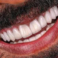 کامپوزیت فکی ۸ میلیون