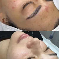 فیشیال تخصصی ، جوانسازی ، پاکسازی ، فیشال صورت|خدمات آرایشگری و زیبایی|یزد, |دیوار