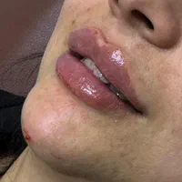 تزریق ژل وبوتاکس هایفو|خدمات آرایشگری و زیبایی|مشهد, کوی سیدی|دیوار