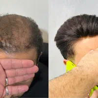 پروتز موی طبیعی بدون جراحی