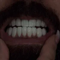 خدمات دندانپزشکی روکش ثابت ترمیم کامپوزیت