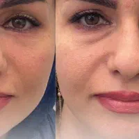جشنوار ۵۰درصد ژل و بوتاکس دکتر محمدشریفی|خدمات آرایشگری و زیبایی|قم, زنبیل آباد|دیوار