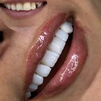 کامپوزیت،لمینیت،روکش،بلیچینگ در دندانپزشکی کیانمهر|خدمات آرایشگری و زیبایی|کرج, کیانمهر|دیوار