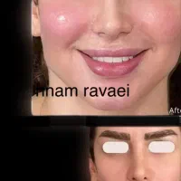 تزریق ژل فول فیس فیلربوتاکس کلینیک دکتربهنام روایی