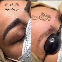 جشنواره تخفیفی ریموو تتو با لیزر