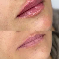 تزریق فیلر / مزوژل / مزوتراپی/ پی ار پی و پی ار اف