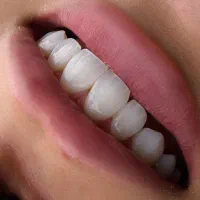 جشنواره کامپوزیت دندان/ کامپوزیت لبه شیشه ای