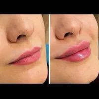 بوتاکس فقط ۶۵۰ فیلر ۸۹۰ مزو ۸۹۰ پی ار پی پزشک مسکن