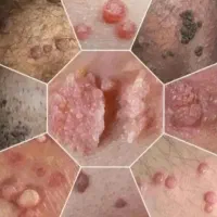 برداشتن خال.زگیل تناسلی.جای زخم و بخیه. میخچه|خدمات آرایشگری و زیبایی|کرمانشاه, |دیوار