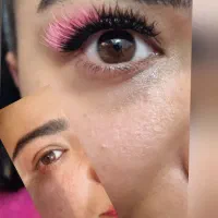 کاشت مژه هیدن