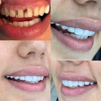 کامپوزیت و لمینت دندان|خدمات آرایشگری و زیبایی|ساری, |دیوار