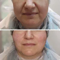 تزریق ژل وبوتاکس