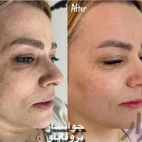 تخصص ما لیزر ژل و بوتاکس حرفه ای و جوانسازی پوست|خدمات آرایشگری و زیبایی|تهران, شهرک ولیعصر جنوبی|دیوار