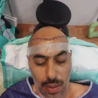 کاشت مو ب روش میکرfit