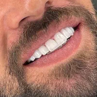 تخفیف ویژه کامپوزیت فقط ۸ میلیون