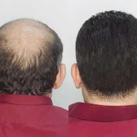 فروش و نصب پروتز موی طبیعی و چسب پروتز ریموور|خدمات آرایشگری و زیبایی|اردبیل, |دیوار