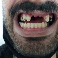 ساخت و تعمیر انواع پروتز های متحرک (دندان مصنوعی)|خدمات آرایشگری و زیبایی|دوگنبدان, |دیوار