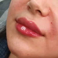 مدل برای تزریق فیلر لب تاپ مدل