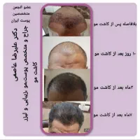کاشت مو پرتراکم همراه با ضمانت نامه کتبی