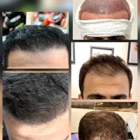 جشنواره کاشت مو وابرو اقساطی
