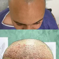 کاشت مو فول تراکم تضمینی|خدمات آرایشگری و زیبایی|گرگان, |دیوار