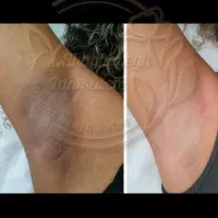 رفع تیرگی بدن،هایفو، بوتاکس، فیلر بادی،نخ لیفت