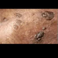 درمان زگیل تناسلی کاملا گیاهی|خدمات آرایشگری و زیبایی|گنبد کاووس, |دیوار