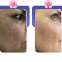 درمان تمامی لک‌ها تنها در یک مراجعه