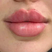 تزریقات زیبایی وجوانسازوفیلرها باتخفیف ویژه