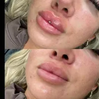 آموزش ژل وبوتاکس2900.چال گونه.آموزش نخ2500.ژل بادی|خدمات آموزشی|اهواز, گلستان|دیوار