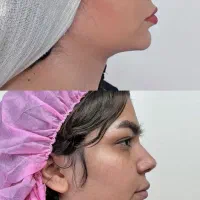 لیپوساکشن غبغب